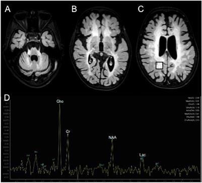 Central Precocious Puberty in a Child With Metachromatic Leukodystrophy